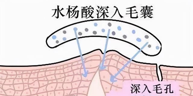 刷酸结果爆了满脸的闭口怎么办，刷酸必看的注意事项