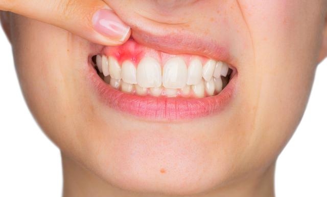 最近牙龈老是出血是什么原因，牙龈出血与这4个因素有关