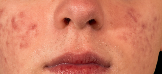 嘴上长疱疹是什么原因，可能是这4种口腔疾病