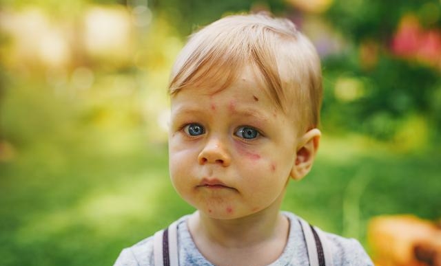 小孩皮肤过敏怎样快速消除，宝宝皮肤过敏快速缓缓解的方法