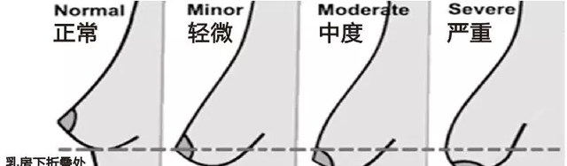 怎么判断胸下垂图解，导致胸部下垂的5个原因