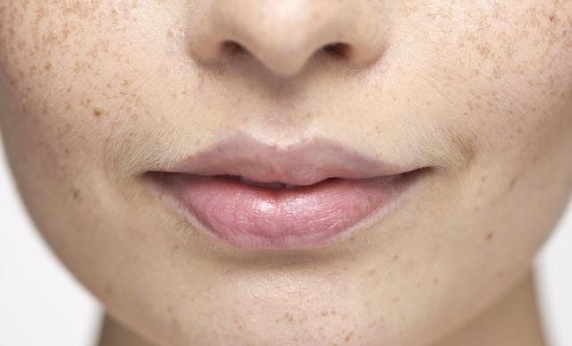脸上长黄褐斑是什么原因引起的，各种斑纹的区别介绍