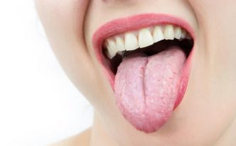 舌头出现齿痕怎么回事「最新舌头出现齿痕原因及恢复方法」