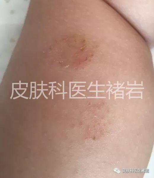 湿疹是什么样的 详细介绍：不同阶段湿疹的表现图片