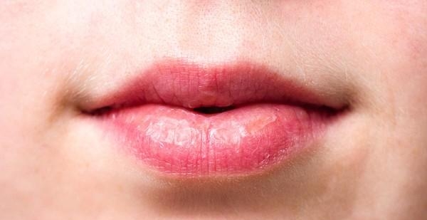 嘴唇起皮干裂缺什么维生素，嘴唇老是干裂的原因