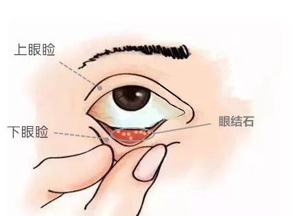 眼睛长结石是什么原因引起的，眼睛里长结石的原因分析