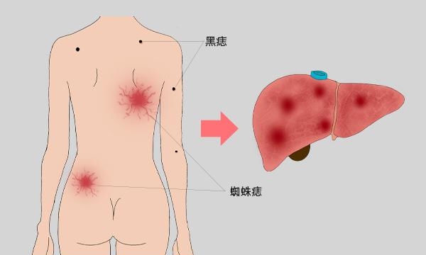 身体出现红色的小血痣什么原因，皮肤突然出现很多小红点的原因