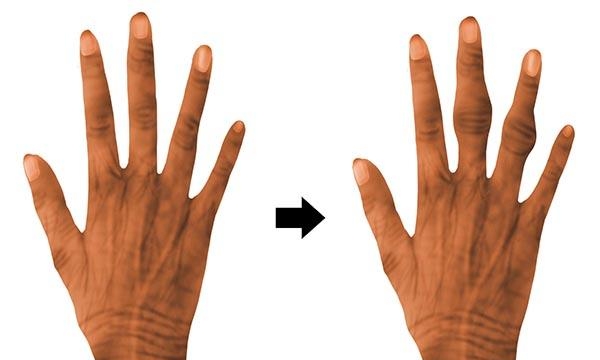 指甲中间凸起来了是什么原因，癌症给的手指2种警告
