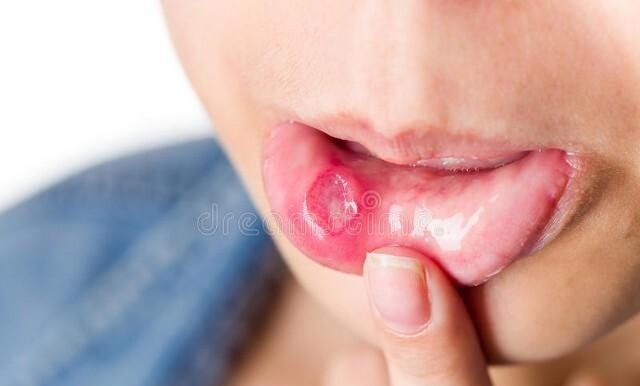 嘴里面起泡怎么办什么原因，口腔内起过包的解决办法