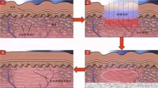 怎样才能去痘疤 新手必看：痘疤原理和具体解决办法