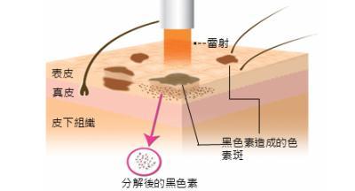 怎样才能去痘疤 新手必看：痘疤原理和具体解决办法