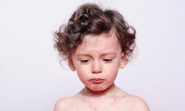 儿童水痘怎么引起的，预防水痘的4条建议