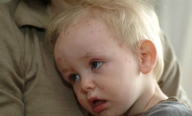 儿童水痘怎么引起的，预防水痘的4条建议