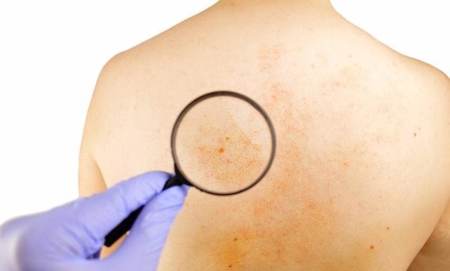 妊娠湿疹是怎么引起的，孕期湿疹的原因及重建皮肤方法