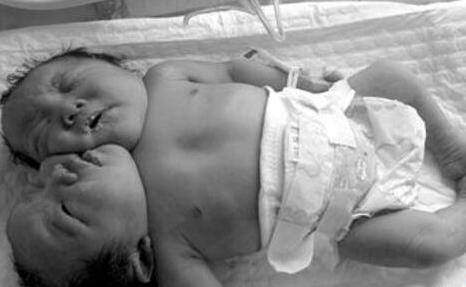 巴西双头婴儿,心脏、肺、肝和骨盆都是共用