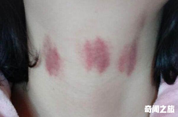 草莓印怎么快速消除掉,脖子上吸吻痕的危害