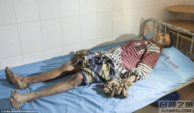 孟加拉国男子患树人病治疗全过程,手和脚长出像树根一样的疣状增生
